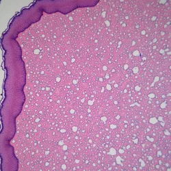 Microscopic examination showing characteristic histological changes in skin tissue affected by Polyester Peasant's Pox, including the distinctive "waffle-pattern" inflammation